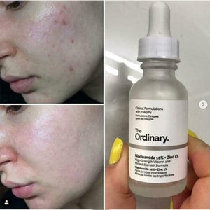 ORDINARY NIACINAMIDE 10% ZINC 1% SERUM